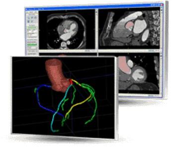 Rcadia公司研发全自动动脉CT血管造影分析系统