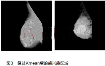 基于Kmean的乳腺肿块检测以及图像预处理的方法