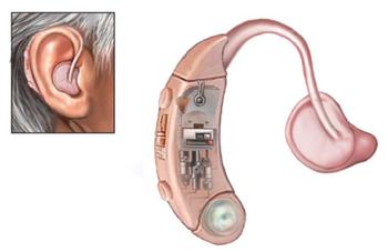 Molex技术革新助听器市场提供平衡电枢音频接收器