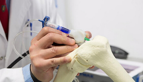 Alphaform通过3D打印技术制造髋骨植入物